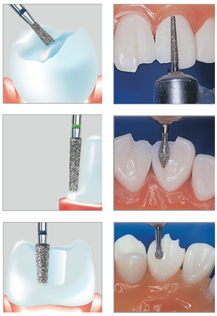 Anwendung Diamantinstrumente