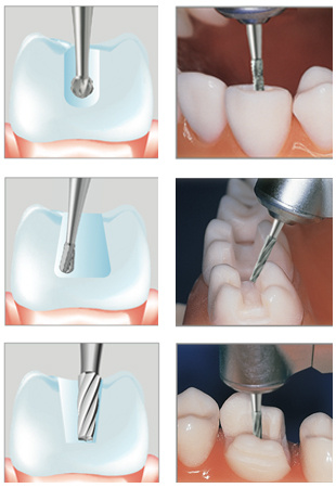 Anwendung Hartmetal Instrumente